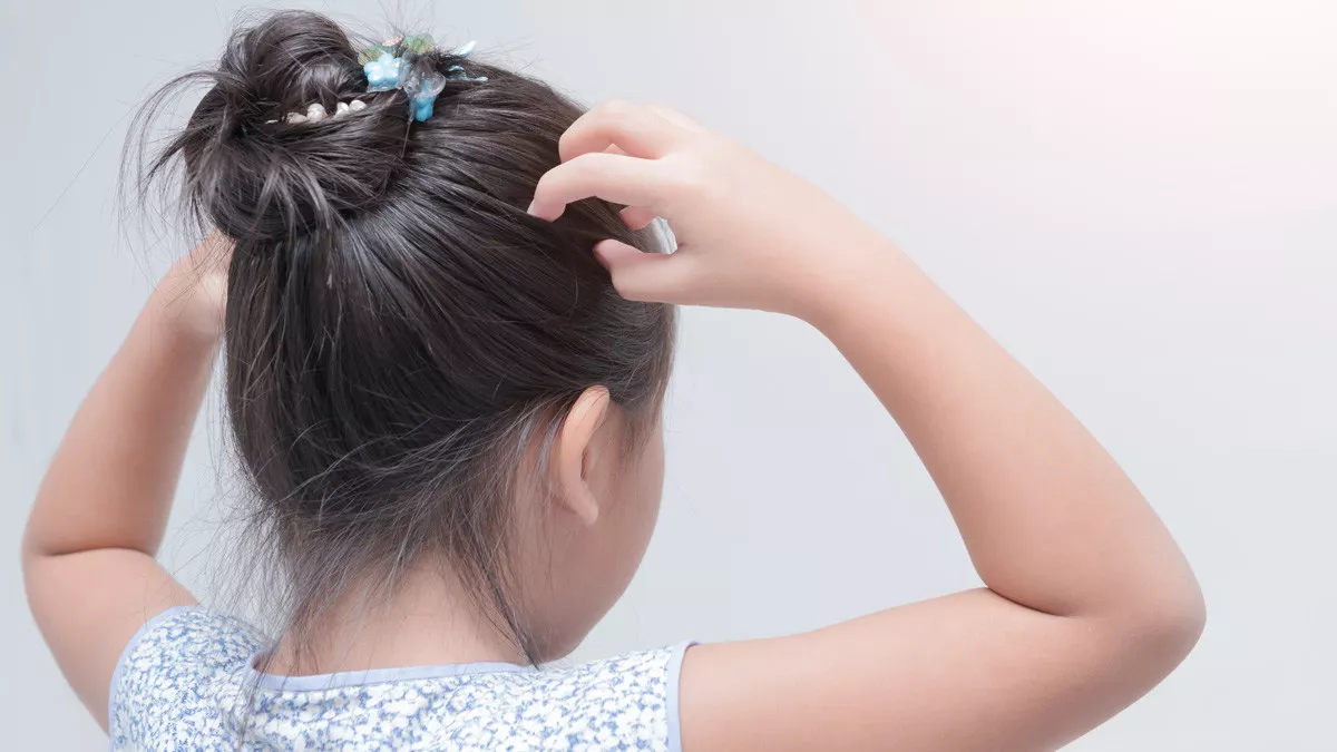 Cara Praktis Atasi Ketombe dan Rambut Rontok pada Anak