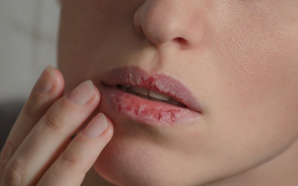 Dermatilomania, Kondisi Sulit Berhenti Mengelupasi Kulit Sendiri