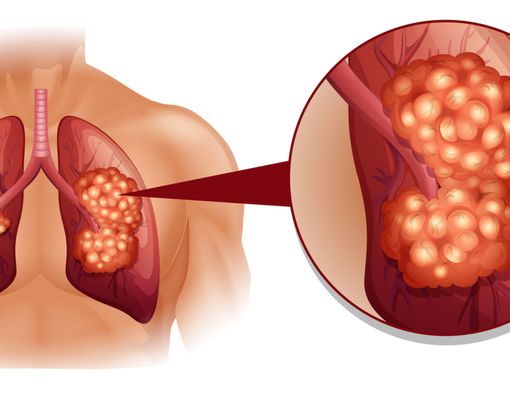 6 Makanan Ini Bisa Menurunkan Risiko Kanker Paru