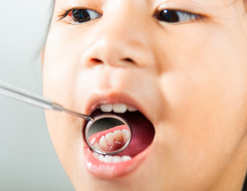 7 Penyebab Gigi Anak Keropos, Orang Tua Harus Tahu!