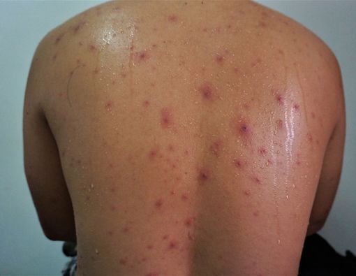 Yuk, Lawan Penyakit Cacar Air Sekaligus Atasi Badan Lemas