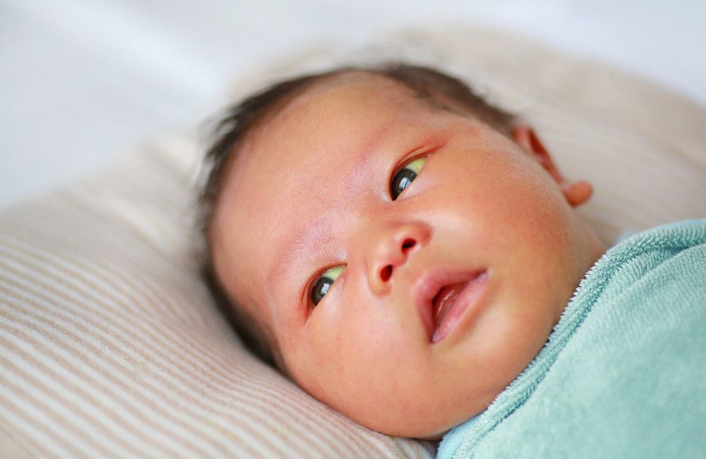 Bayi Kuning Hari Pertama Kelahiran Penyebab Kejang pada Anak