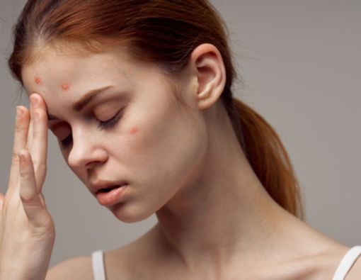 Sudah Bukan Remaja tapi Jerawat Masih Muncul, Ini 6 Penyebabnya