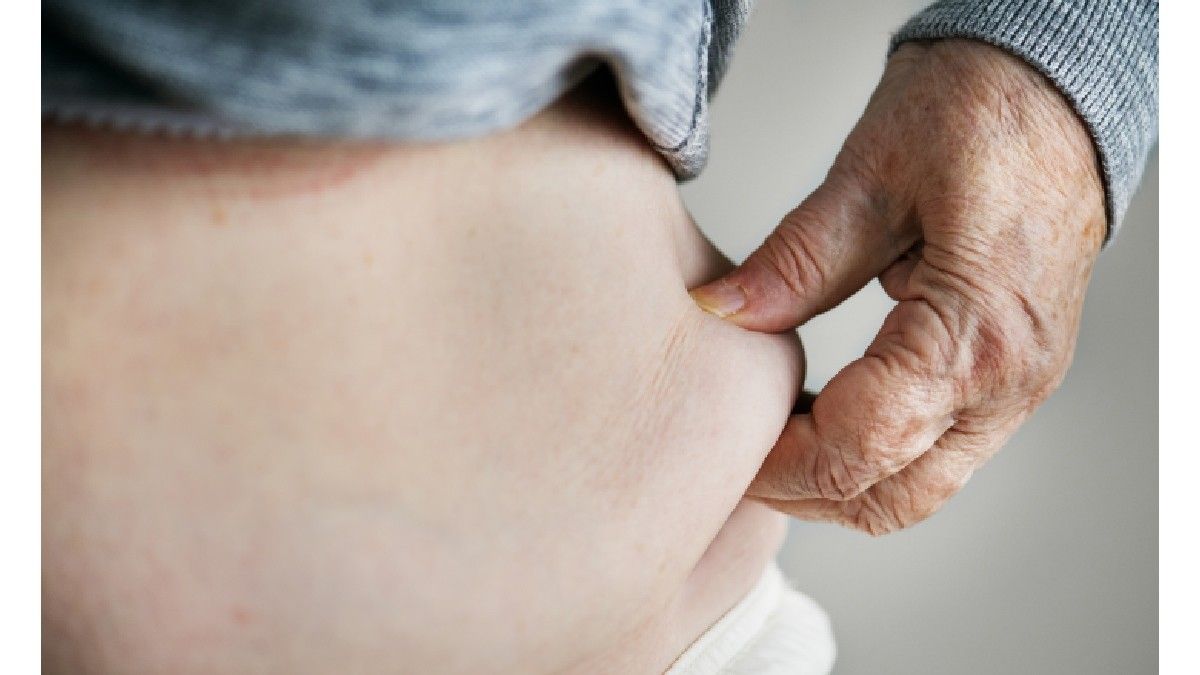 Obesitas Bisa Menurunkan Kepadatan Tulang dan Massa Otot?