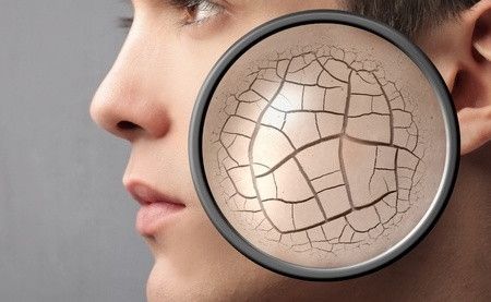 Cara Mengatasi Kulit Kering 