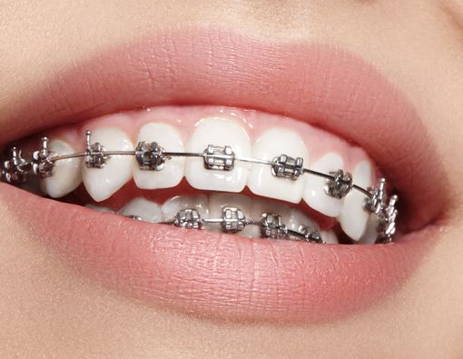 Benarkah Pakai Behel Bisa Bikin Gusi Turun?