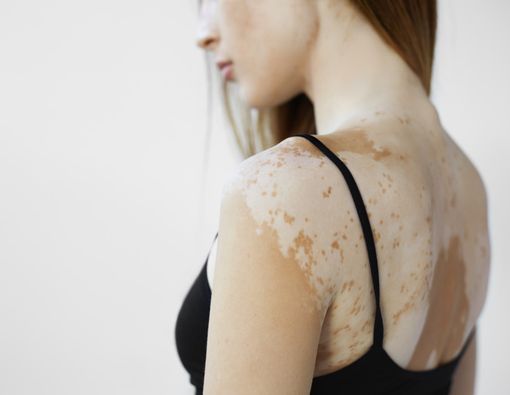 Sulitkah Mengenali Vitiligo pada Orang Berkulit Putih?