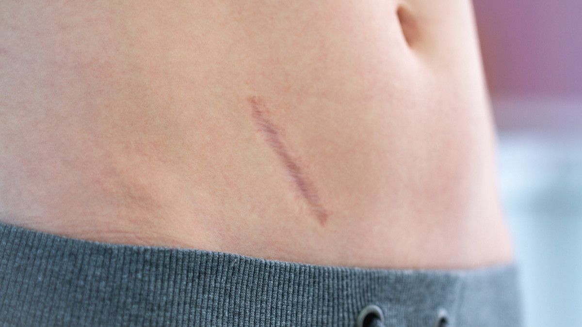 Luka Tusuk Bisa Sebabkan keloid?