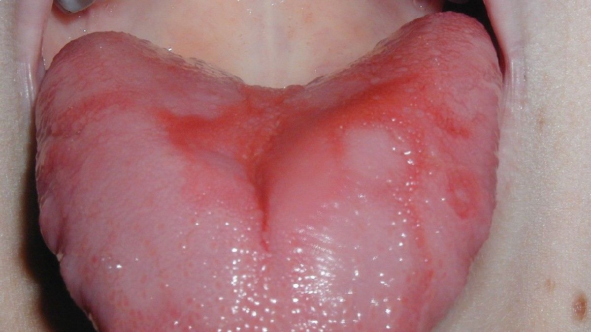 Cara Mengatasi Burning Mouth Syndrome Sesuai Jenisnya
