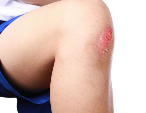 7 Obat Alami untuk Sembuhkan Luka dengan Cepat	