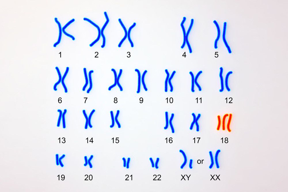Mengenal Edwards Syndrome Lebih Jauh