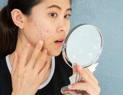 Hati-hati! Sering Naik Pesawat Bisa Tingkatkan Risiko Wajah Jerawatan