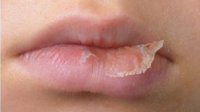 Cegah Bibir Kering Selama Puasa dengan 4 Langkah Ini