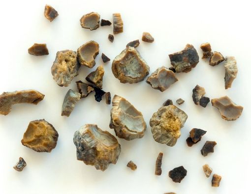 Kenali Penyebab Batu Ginjal Berdasarkan Jenisnya