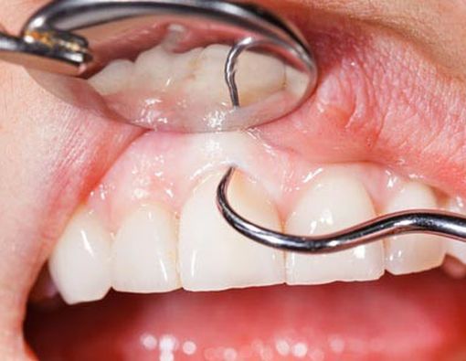 5 Tanda Kerusakan Pada Jaringan Pendukung Gigi