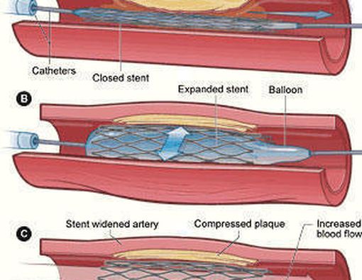 Stent Arteri Koroner