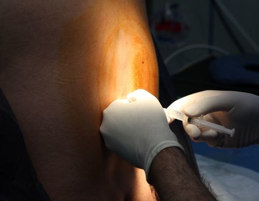 Deretan Mitos dan Fakta Bius Epidural saat Melahirkan