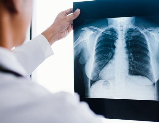 Mengenal Manfaat Rontgen Thorax dan Prosedurnya