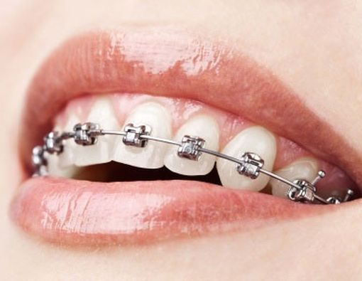 Pasang Kawat Gigi di Tukang Gigi, Amankah?