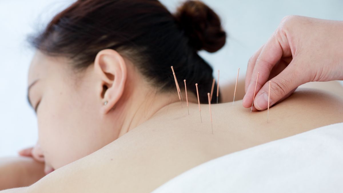 Mengenal Manfaat Akupunktur untuk Kesehatan