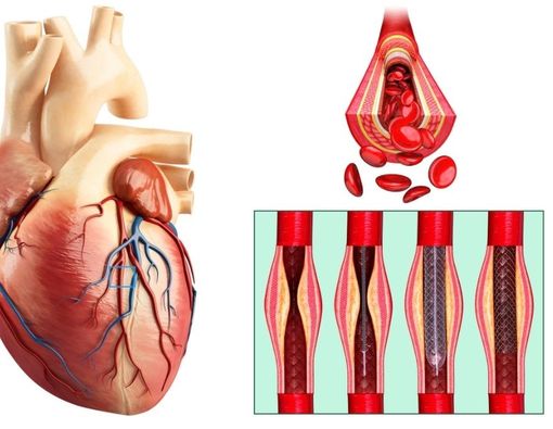 Pilih Operasi Bypass atau Pasang Stent untuk Atasi Jantung Koroner?