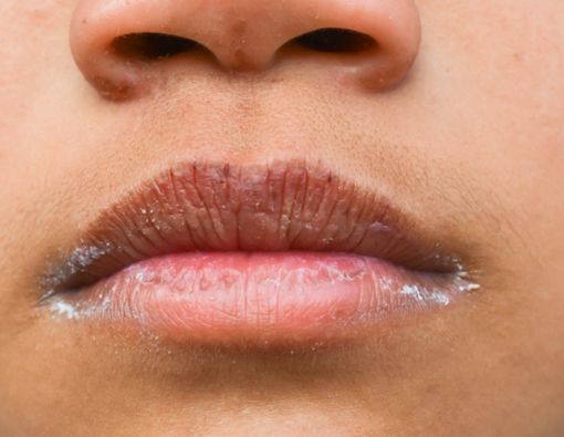 Penyakit Mulut pada Penderita HIV dan Pengobatannya