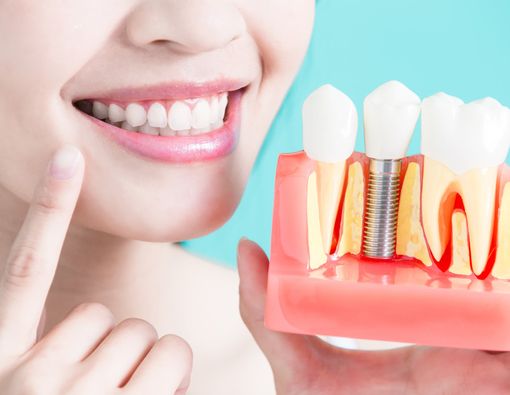Plus dan Minus Memakai Implan Gigi