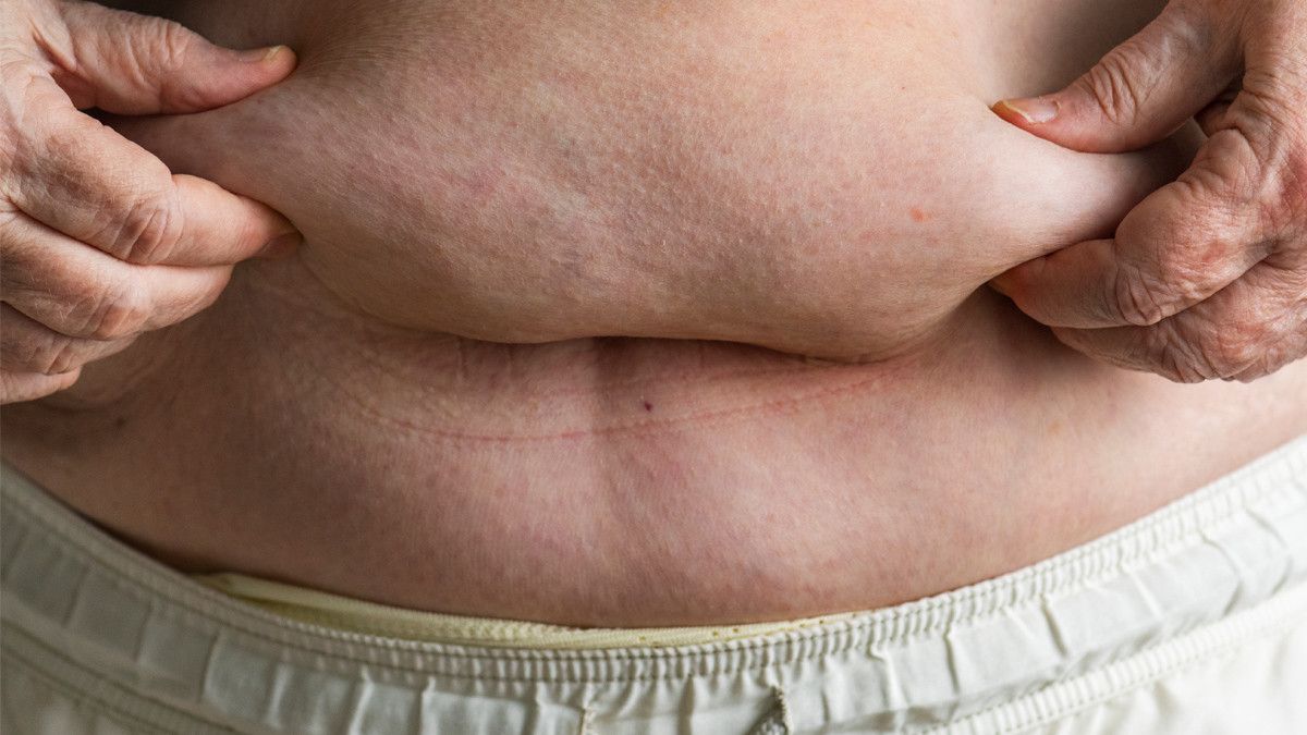 Waspada, Obesitas Bisa Menjadi Faktor Risiko Kanker Kolon
