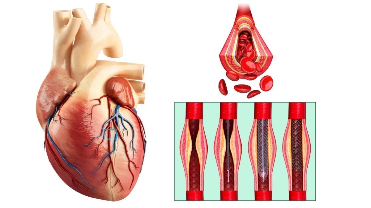 Pilih Operasi Bypass atau Pasang Stent untuk Atasi Jantung Koroner?