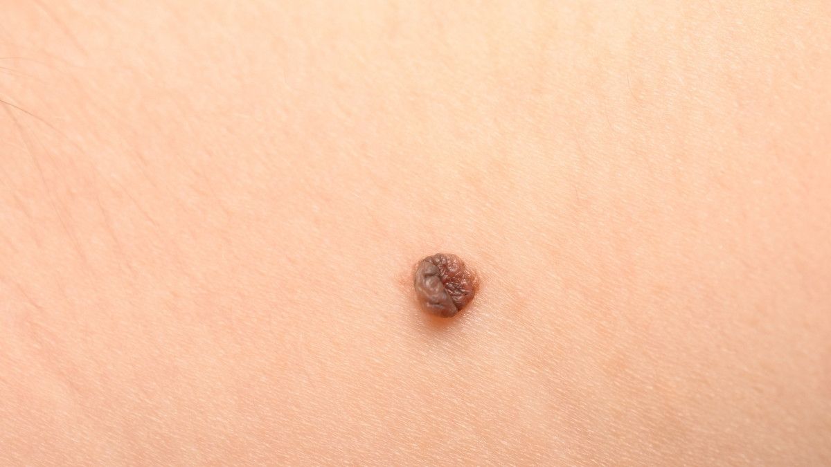Keratosis Seboroik