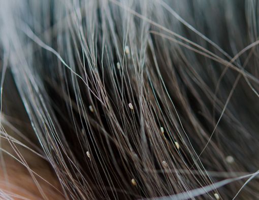 Amankah Basmi Kutu Rambut dengan Minyak Kayu Putih?