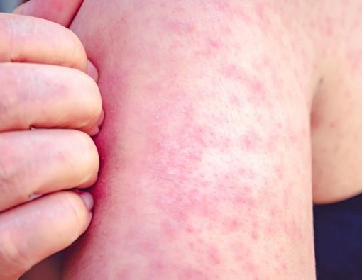 Penyakit Kulit Dermatitis Numularis, Bisakah Disembuhkan?