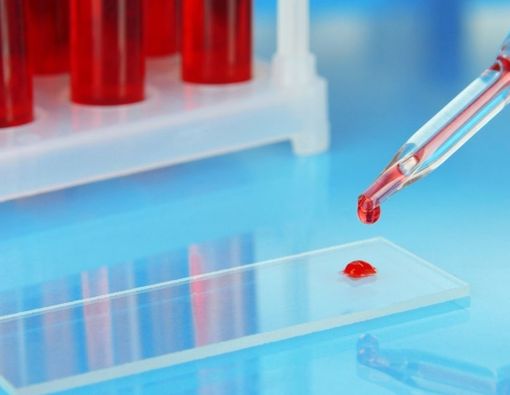 Mengenal Tes Anion Gap untuk Diabetes