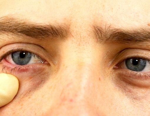 Waspada, Ini Efek Samping Steroid pada Penglihatan Anda