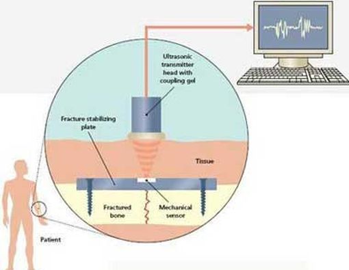 Ultrasound Sebagai Pengobatan Tulang Retak
