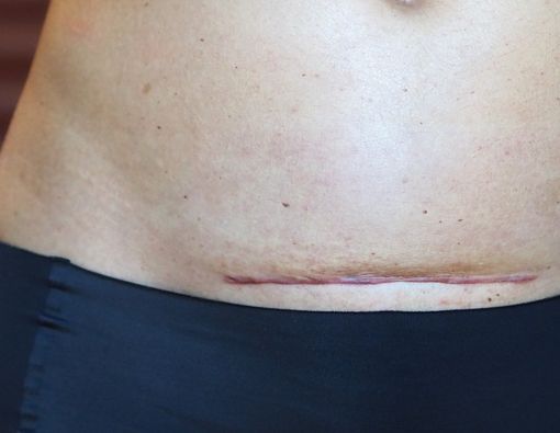 Berapa Lama Pemulihan Luka Bekas Operasi Caesar?