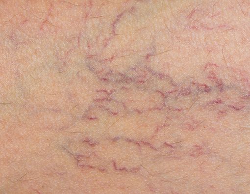 Bahaya Varises Vagina Saat Hamil