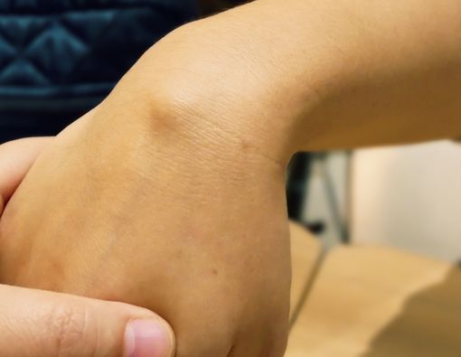 Kista Ganglion, Salah Satu Penyebab Benjolan di Tangan