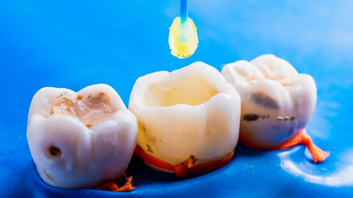Kenapa Tambalan Gigi Sering Lepas? Ini Penyebabnya