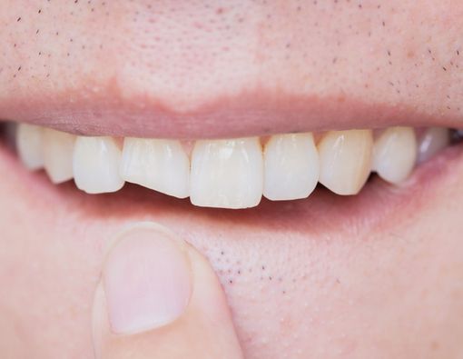 Gigi Retak atau Patah, Ini Cara Menanganinya