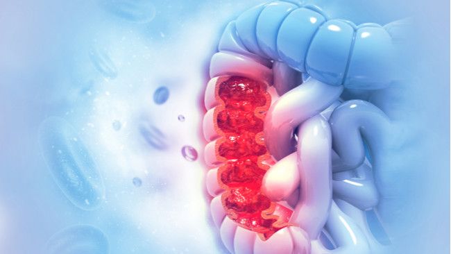 Vitamin D Bisa Bantu Melawan Kanker Usus Besar?