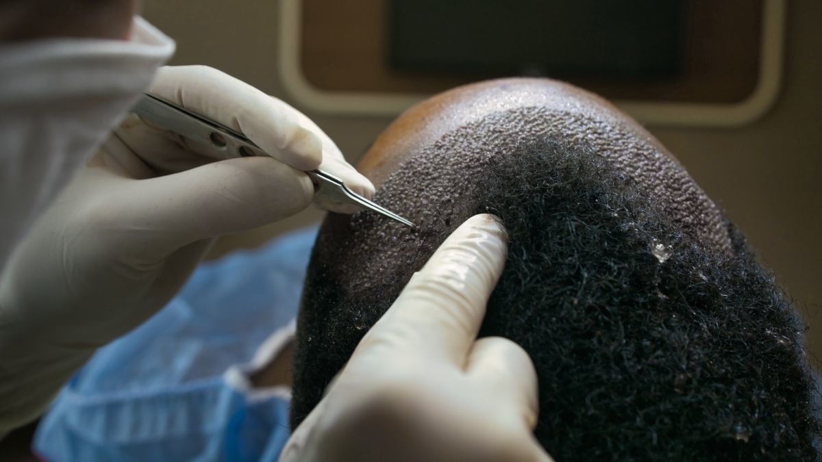 Mengenal Proses Transplantasi Rambut dan Efek Sampingnya
