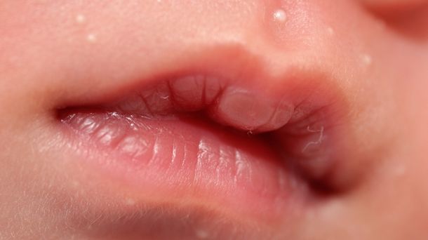 Mengenal Kondisi Lip Blister atau Suck Blister pada Bayi