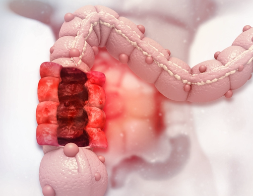 Perlu Tahu, Ini Harapan Hidup Penderita Kanker Kolon Stadium 3