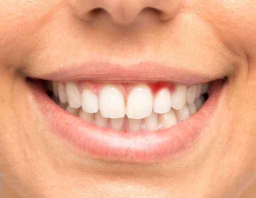 Penyakit Berbahaya dengan Gejala Gusi Berdarah