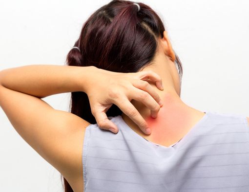 Infeksi Jamur di Kulit, Hilangkan dengan Cara Ini