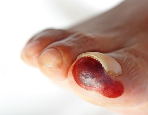Pilihan Pengobatan Luka Gangrene untuk Penderita Diabetes