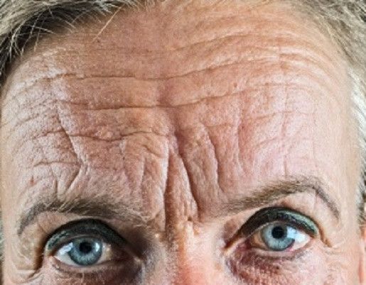 6 Hal Seputar Kerutan di Wajah