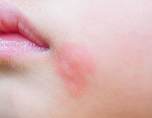 Si Kecil Alergi Susu, Apa yang Harus Bunda Lakukan?