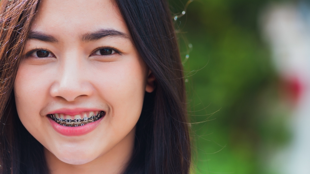 9 Efek Samping Kawat Gigi yang Harus Kamu Tahu